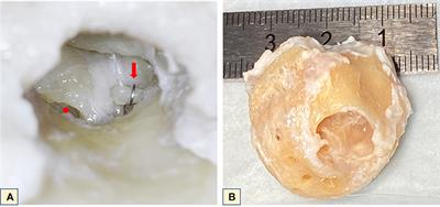Otosclerosis under microCT: New insights into the disease and its anatomy